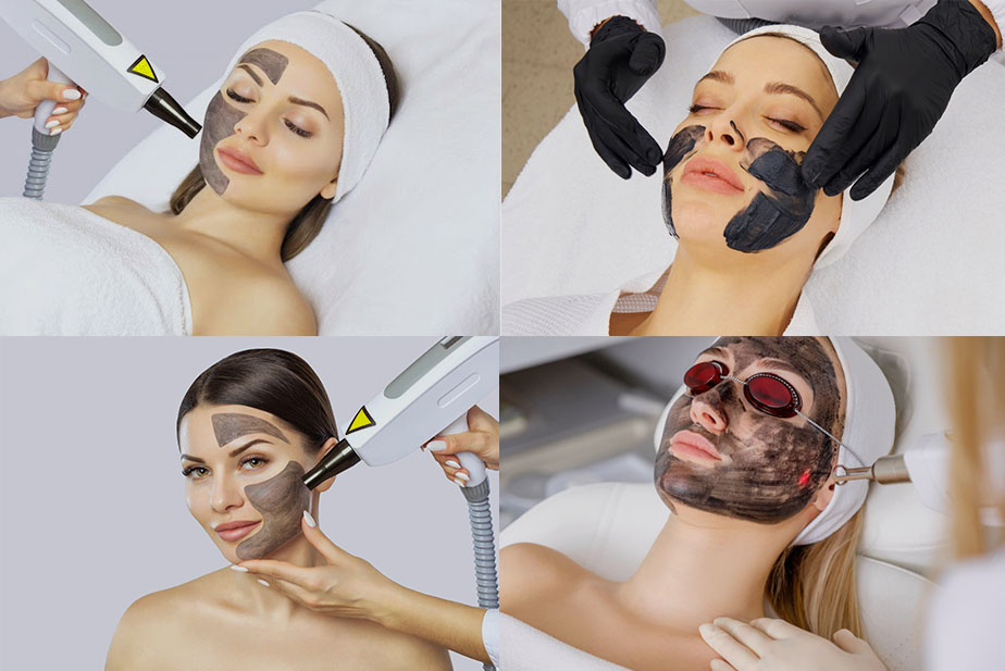 What is a Carbon Laser Facial?