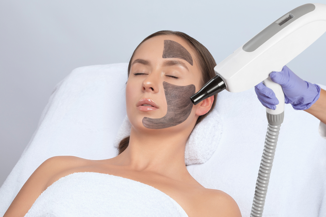 Carbon Laser Facial