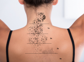 Tattoo Removal
